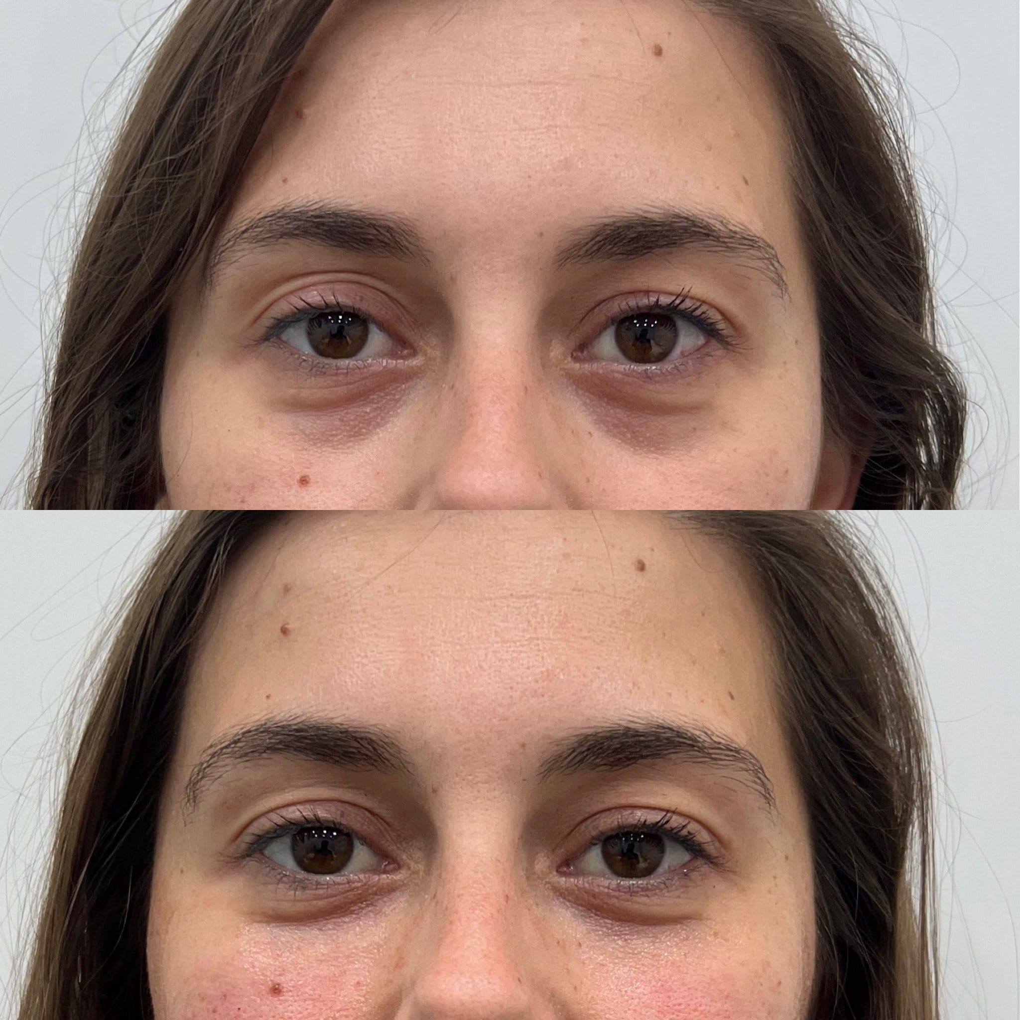 Corrección de ojeras con ácido hialurónico Lemont Clinic